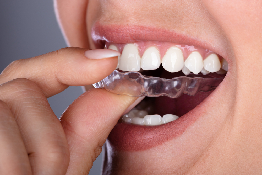 A woman is putting in her invisalign, a cosmetic dental treatment.