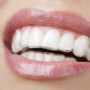 Woman wearing clear aligners