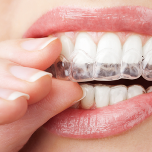 Young woman putting in clear aligners