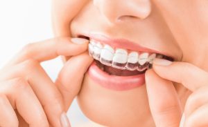 woman putting on a clear aligner